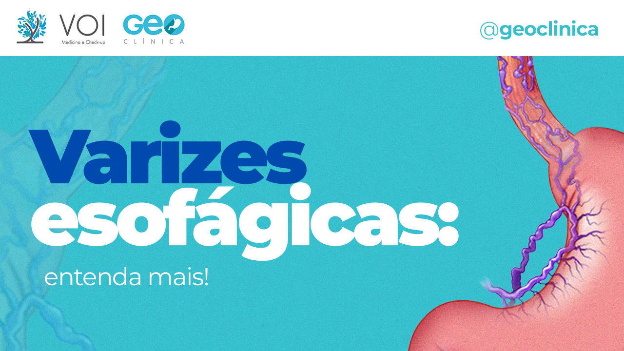 Varizes